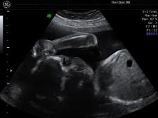 Early pregnancy scans
