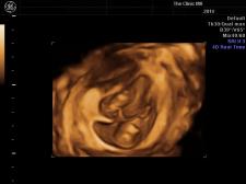 3D Early Twins